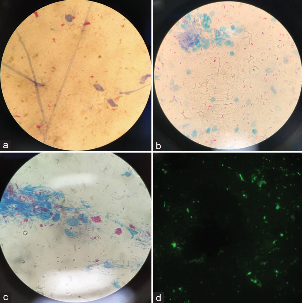 Leprosy smears (Modified Ziehl -Neelsen staining). (a) BI 4+: 10–100 bacilli in a single oil immersion field, (b) BI 5+: 10–100 bacilli in a single oil immersion field, (c) BI 6+: globi (> 1000 bacilli) in a single oil immersion field, (d) Mycobacterium leprae highlighted on fluorescent staining, showing solid, fragmented, and granular bacilli (HiMedia® K021-1KT).