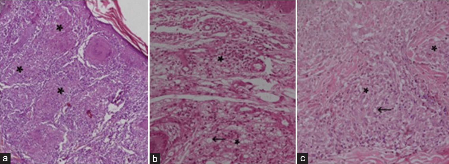 (a) Multiple compact epithelioid cell granulomas (*) predominantly composed of lymphocytes and foreign body giant cells with granulomas abutting epidermis at focal points suggestive of borderline tuberculoid leprosy (H&E, ×200), (b) multiple loosely formed granulomas (*) composed of lymphocytes and foam cells (black arrow) suggestive of borderline lepromatous leprosy (H&E, ×400), and (c) loosely formed granulomas (*) predominantly composed of macrophages, with sheets of foamy cells (black arrows) suggestive of lepromatous leprosy (H&E, × 400) (Image Courtesy: Dr. Kumari Ritu).