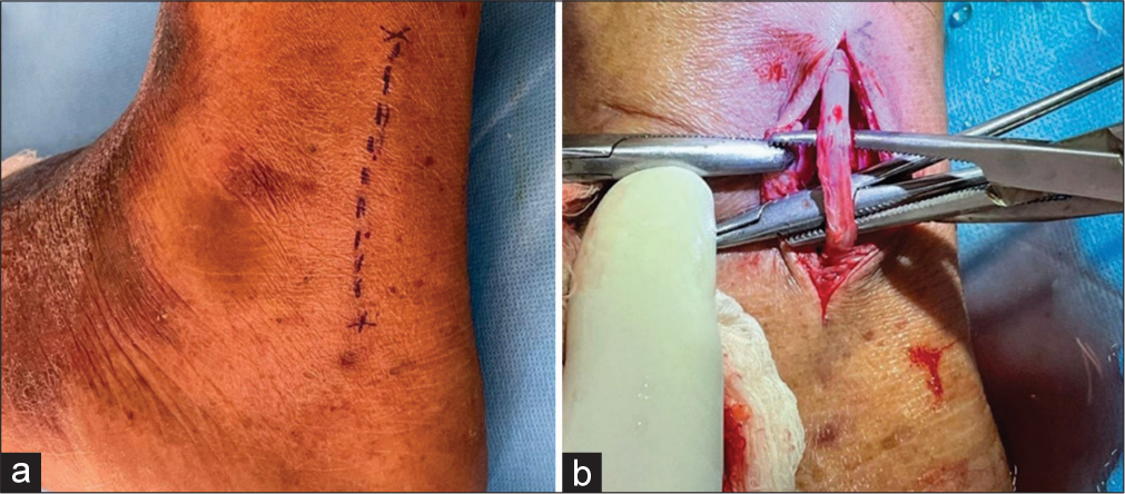 (a and b) Marking and dissection of sural nerve in nerve biopsy (Image: Khurana A. Diagnosis of leprosy. In: Sardana K, Khurana A, editors. Jopling’s Handbook of Leprosy. 7th ed. New Delhi: CBS publishers; 2023).