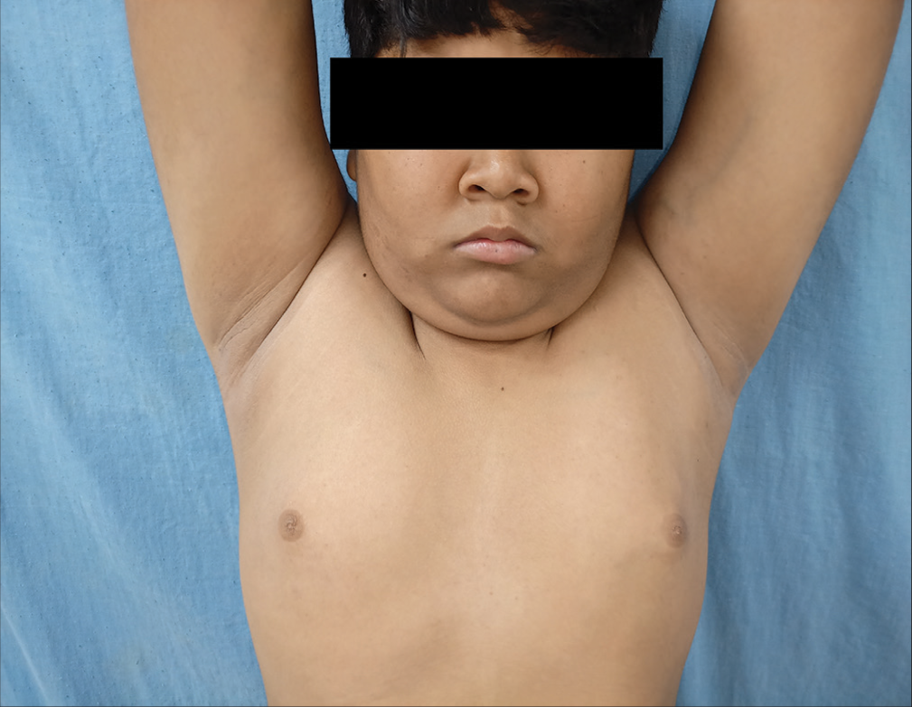 Acanthosis nigricans with absence of axillary hair.