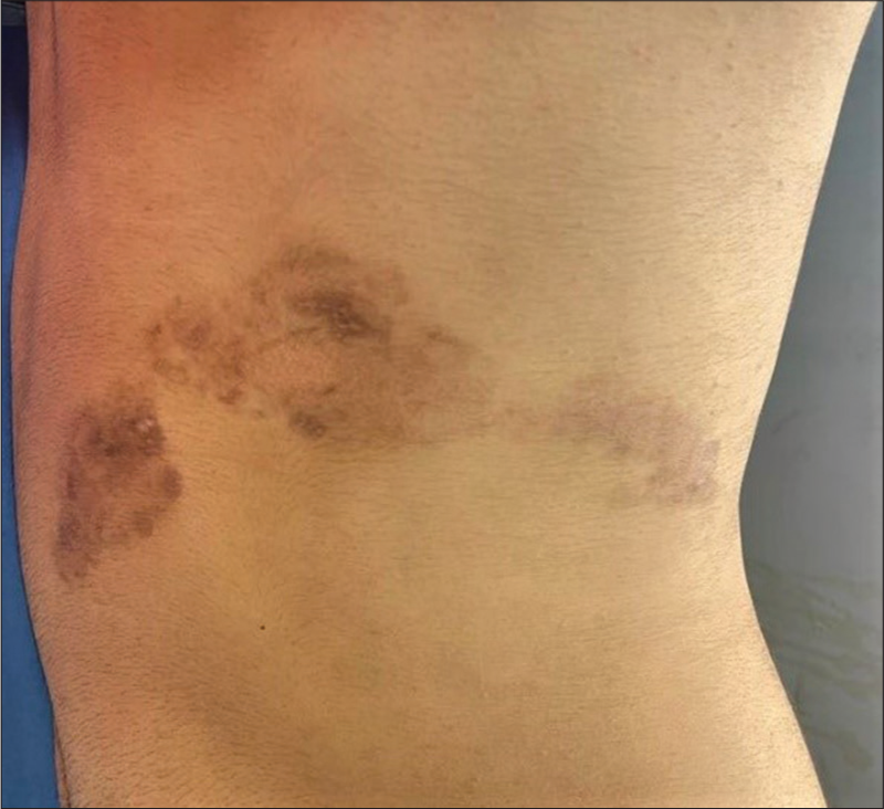 Left lateral view of abdomen (Post 5th session of fractional CO2 laser).