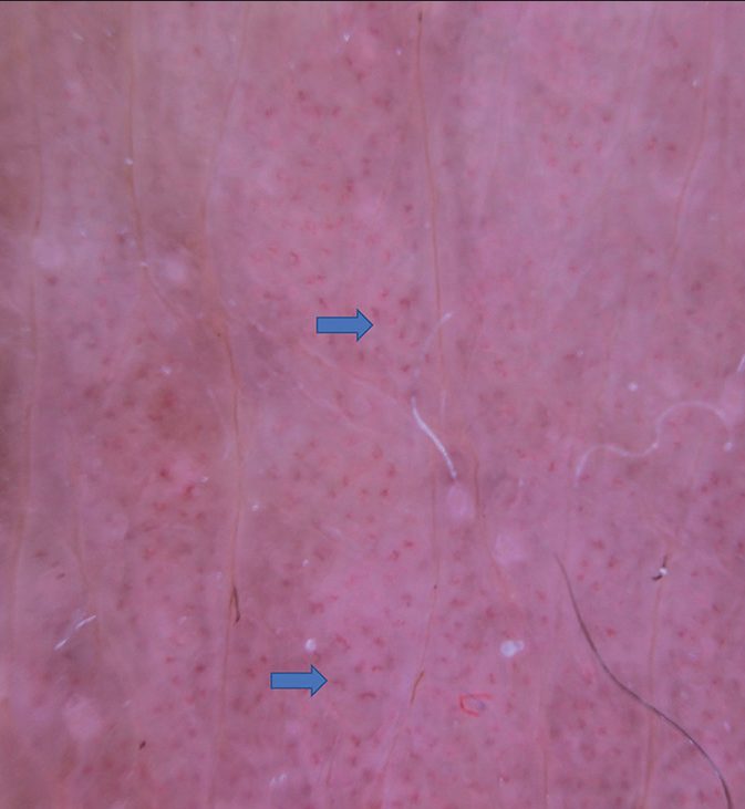 Dermoscopy reveals the presence of irregular linear vessels (Blue arrows).