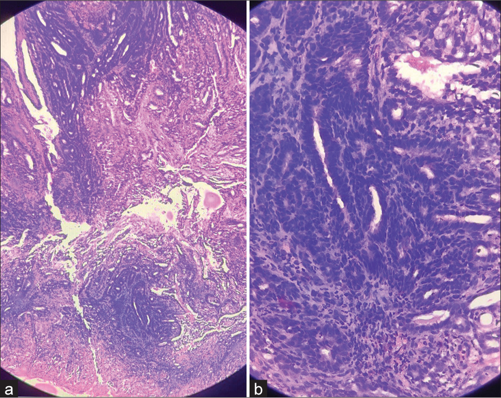 Haematoxylin-Eosin-stained section - (a) ×10 magnification view showing slender fronds of connective tissue. (b) ×40 magnification view showing an outer columnar epithelial layer and inner myoepithelial cells layer.