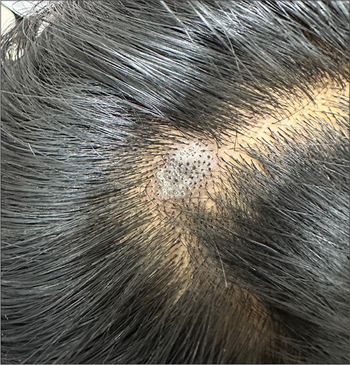 Solitary well-defined lichenoid plaque over the vertex of the scalp.