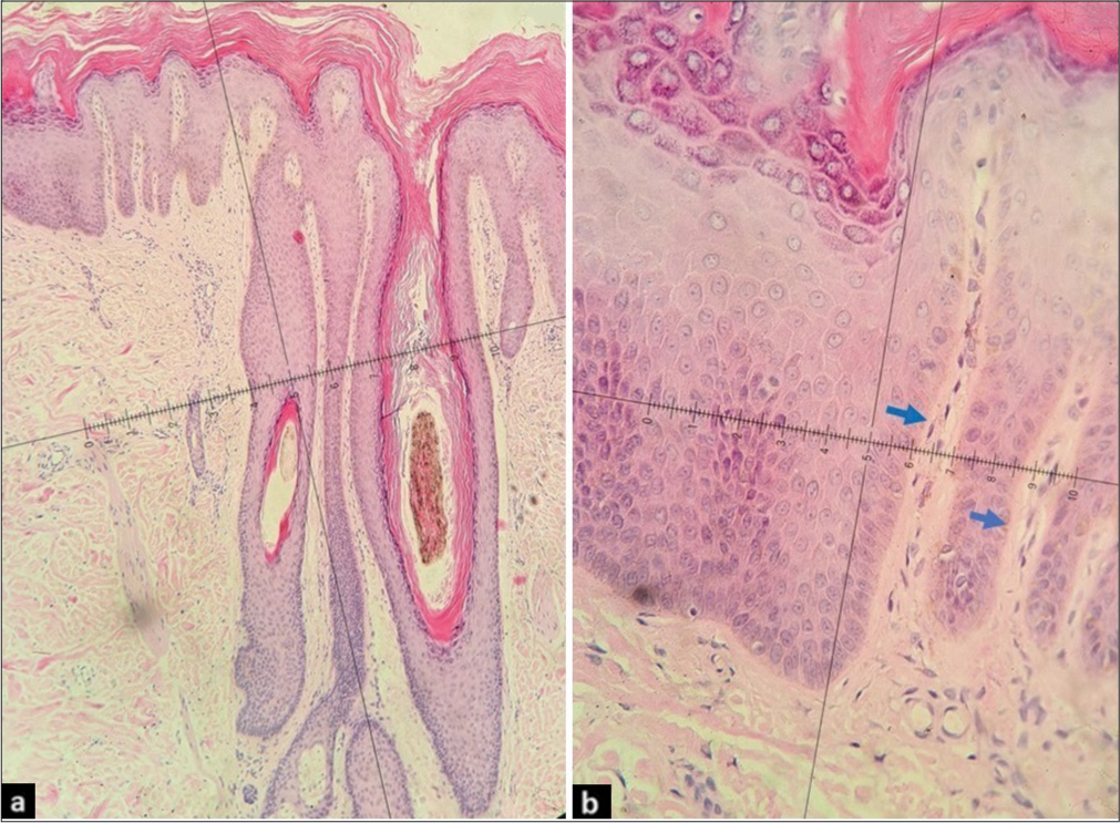 (a) Haematoxylin and Eosin (H and E) (×10 magnification) – marked hyperkeratosis, hypergranulosis and acanthosis with regular elongation of rete ridges, no hair-shaft deformity. (b) H and E (×40 magnification) – vertically arranged collagen fibres (blue arrows) with non-specific dermal infiltration.