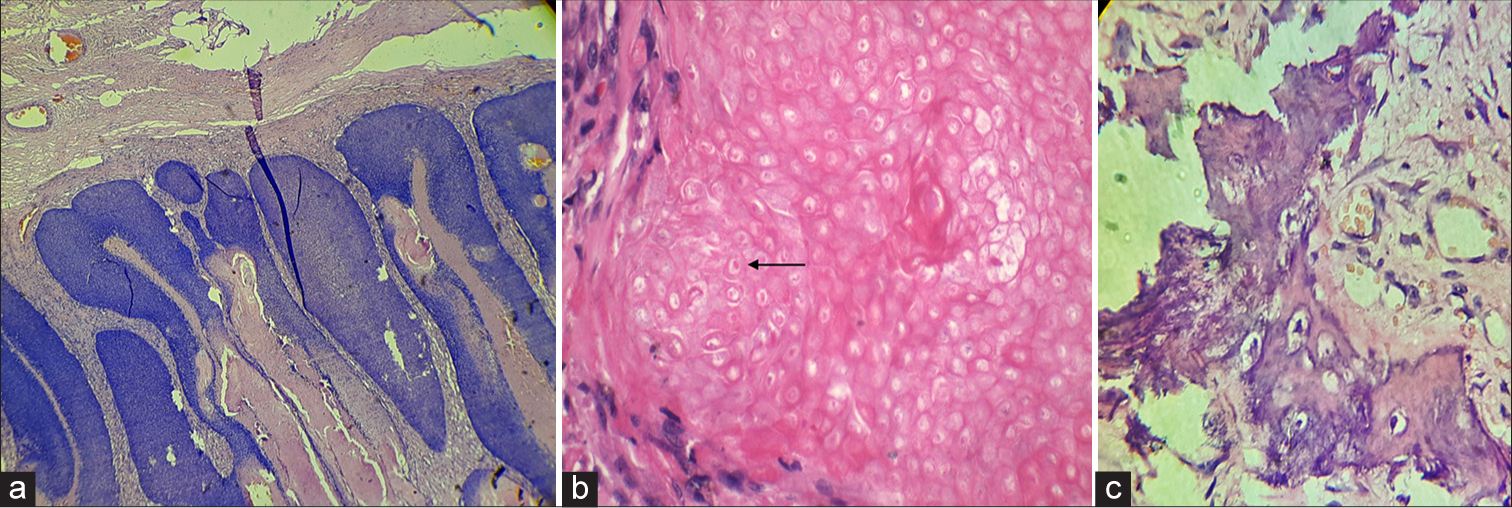 Histopathology of giant ulcerating pilomatricoma showing (a) well-circumscribed unencapsulated neoplasm involving the whole dermis, composed of aggregates of basaloid matrical cells aligned at the periphery and shadow cells centrally (H&E ×10) (b) shadow cells (black arrow) in H&E ×40 (c) Foci of metaplastic ossification (H&E ×40). H&E: haematoxylin and eosin.