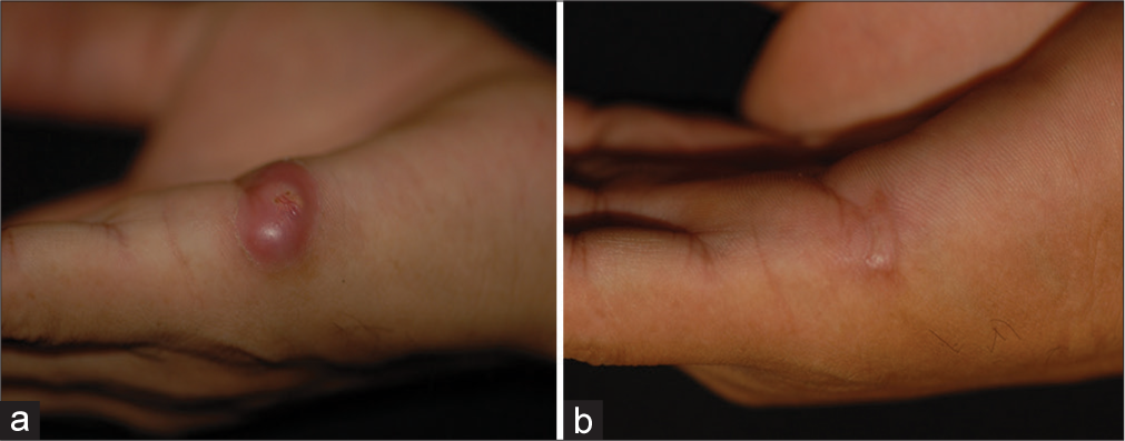 (a) An erythematous, stiff, 7 mm diameter nodule with superficial erosion in the centre, localised to the right hand, affecting the lateral metacarpal area. (b) Resolution of the lesion after treatment.