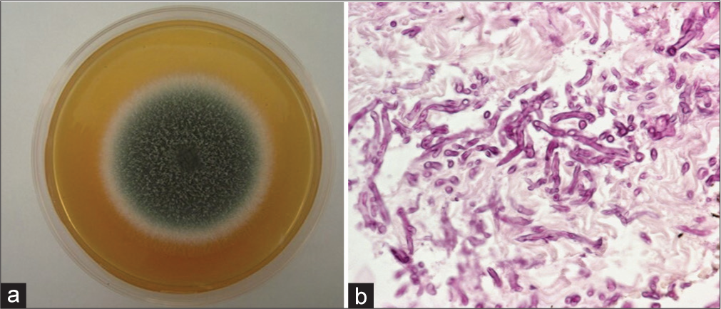 (a) Tissue culture on Sabouraud medium: Velvety colonies with an olive-green coloration and a whitish peripheral halo (b) Histological sections stained with periodic acid-Schiff: Multiple septate hyaline hyphae, including cross-sections, longitudinal sections and oblique sections 40x.