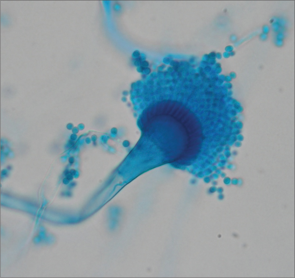 Direct examination of cultures: Septate, tabulated and hyaline mycelium, as well as Aspergillus heads composed of long conidiophores, round vesicles from which two series of phialides emerge and round microconidia originating from the latter.
