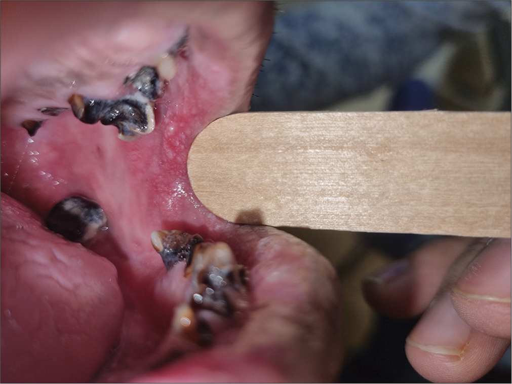 Clinical image to demonstrate palpation of a lesion (leukoplakia) on left buccal mucosa using wooden spatula.