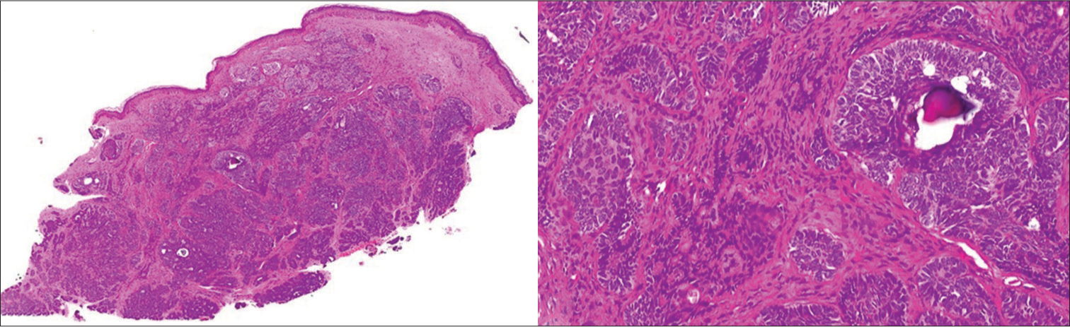 (a) Dermis shows a multilobulated, circumscribed neoplasm arranged as nests, cords, reticular and cribriform pattern, with few papillary mesenchymal bodies (haematoxylin and eosin [H & E] ×2). (b) Bland appearing trichoblastic cells with peripheral palisading, with no evidence of atypia or mitosis (H & E ×20).