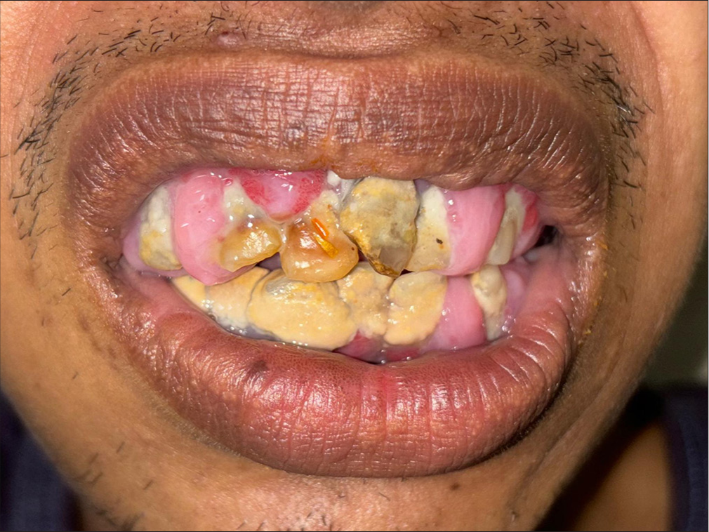 Phenytoin-induced gingival enlargement.