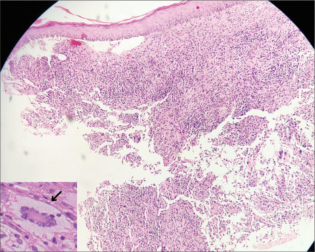 Dermoscopy of Giant Juvenile Xanthogranuloma - Indian Journal of ...