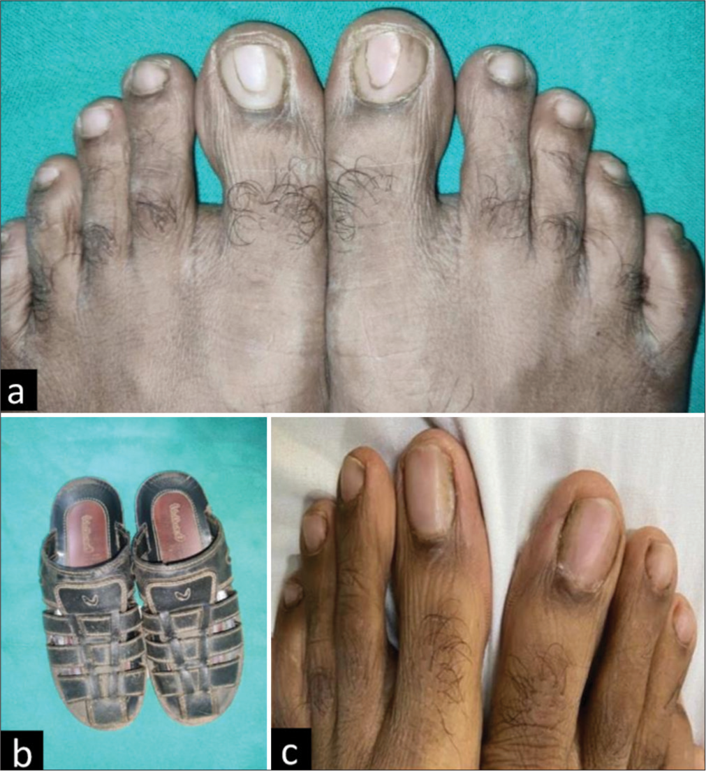 (a) Triangular area of thinning and redness seen on both great toe nails, (b) anteriorly closed shoes and (c) improvement after changing the shoes.