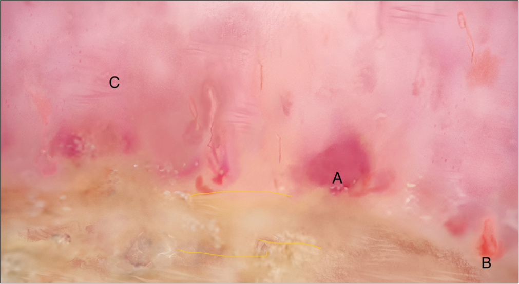 Dermoscopy shows (A) few microhemorrhages, (B) few dilated capillaries and (C) background erythema.