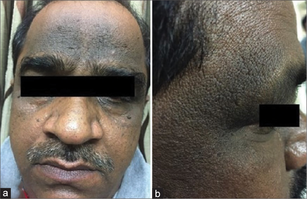 (a) Horizontal band like pigmentation over the forehead with thickened skin and velvety texture and (b) blackish pigmentation over the temporal region with mild thickening of skin.