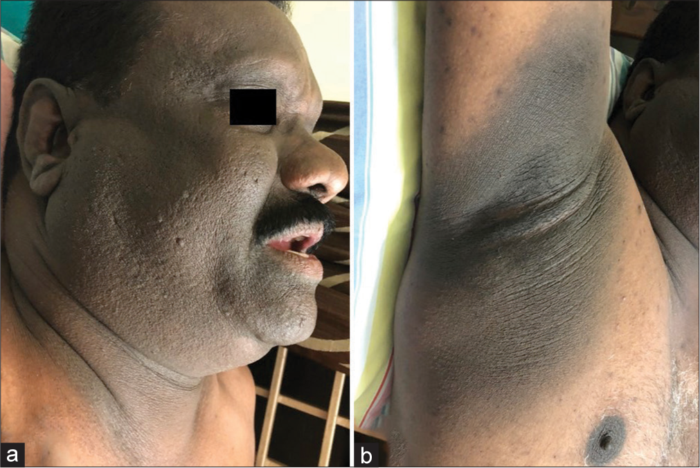 (a) Diffuse pigmentation all over the face and neck with mild thickening and roughness of skin and (b) diffuse pigmentation and thickening of skin over the axilla extending onto the surrounding areas.