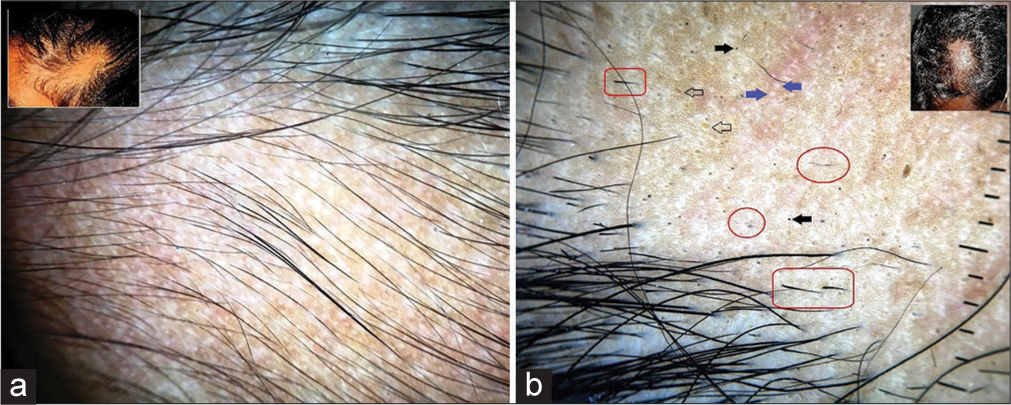 (a) inset: clinical image. Trichoscopy in a case of temporal triangular alopecia showing sheet of vellus hairs. (b) inset: clinical image. A case of alopecia areata with similar location on the scalp showing numerous black dots (black solid arrows), yellow dots (black hollow arrows), short vellus hairs (red circles), exclamation mark hairs (red rectangles) and numerous empty follicles (blue arrows). (DermLite™ DL3 [3Gen Inc., San Juan Capistrano, CA, USA], ×10 polarized).