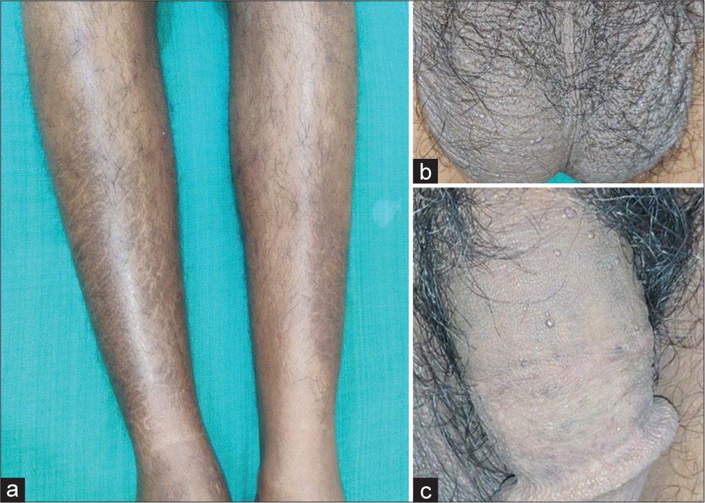 (a) Ichthyotic macules on legs. (b) Skin-coloured papules on the scrotum. (c) Skin-coloured papules on the shaft of the penis.