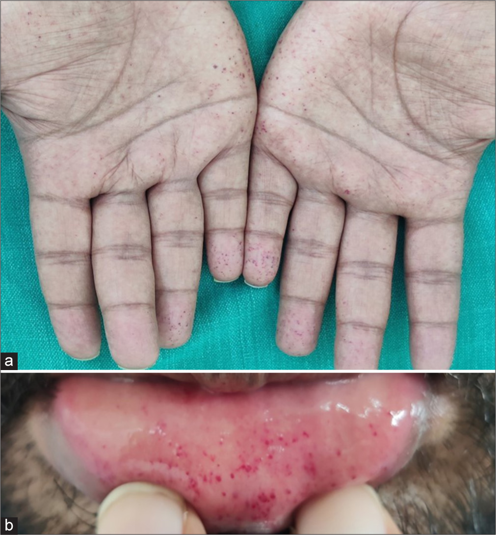 (a) Non-blanchable reddish macules on palms. (b) Nonblanchable reddish macules on lips.