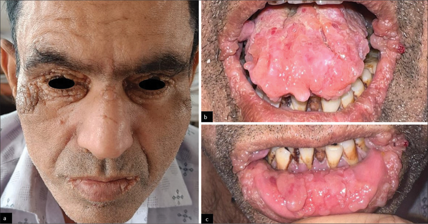 (a) Multiple, skin-coloured papules over nasal bridge, bilateral periorbital, retroauricular, perinasal and perioral region. (b) Infiltrated papules and plaques over labial mucosa. (c) Macroglossia with scalloping.