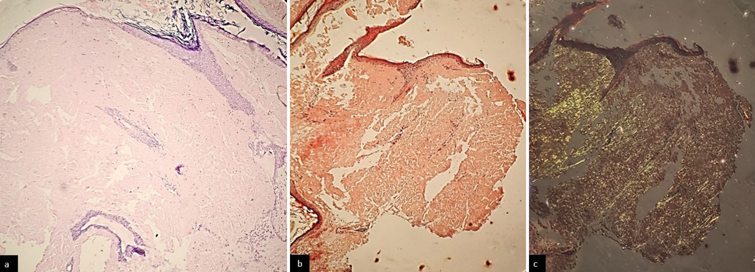 (a) Histopathology (H&E) showing atrophied epidermis with dense, amorphous, eosinophilic, hyaline extracellular deposits in the dermis (×20). (b) Amyloid deposits showing orangered colour with Congo red stain on routine microscopy (×20). (c) Amyloid deposits showing apple-green birefringence with Congo red on polarised microscopy (×20). H&E: Haematoxylin & Eosin.