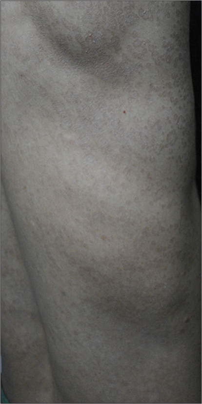 Multiple discrete to coalescing hyperpigmented brownish scaly macules distributed over the right side of trunk.