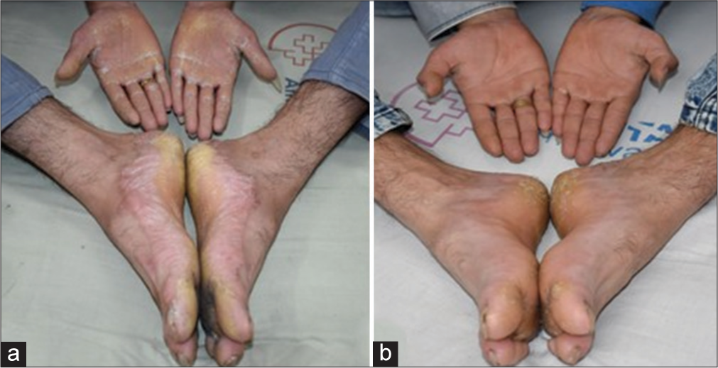 First patient (a) diffuse, transgradient palmoplantar keratoderma over bilateral palms and soles (b) response after 3 months of acitretin.