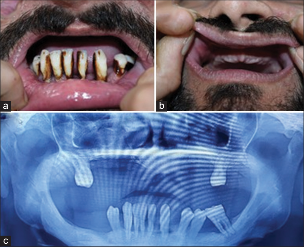 First patient (a) lower teeth showing plaque accumulation and deep periodontal pockets, (b) loss of majority of upper teeth and (c) orthopantogram showing ‘floating in air’ appearance with resorption of alveolar process.