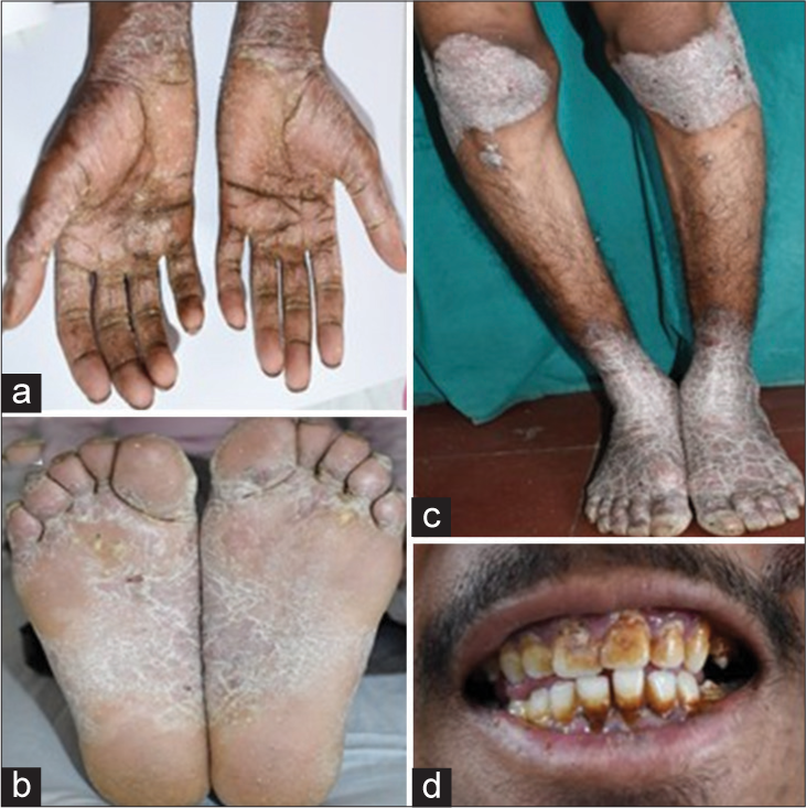 Second patient (a and b) diffuse, transgradient palmoplantar keratoderma over bilateral palms and soles, (c) Psoriasiform plaques over bilateral knees and (d) plaque accumulation and carious teeth.