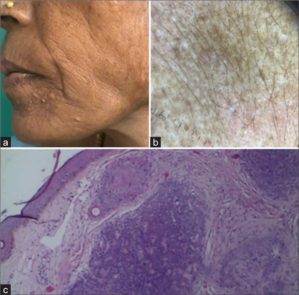 (a) Trichoepithelioma – Clinical photograph shows dome-shaped to flat skin-colored papules. (b) Dermoscopy showing hyperpigmented dots and circles with background erythema and multiple structureless white areas. (c) Histopathology showing tumor islands sharing cribriform pattern with germ and papilla structures (Magnification ×100).