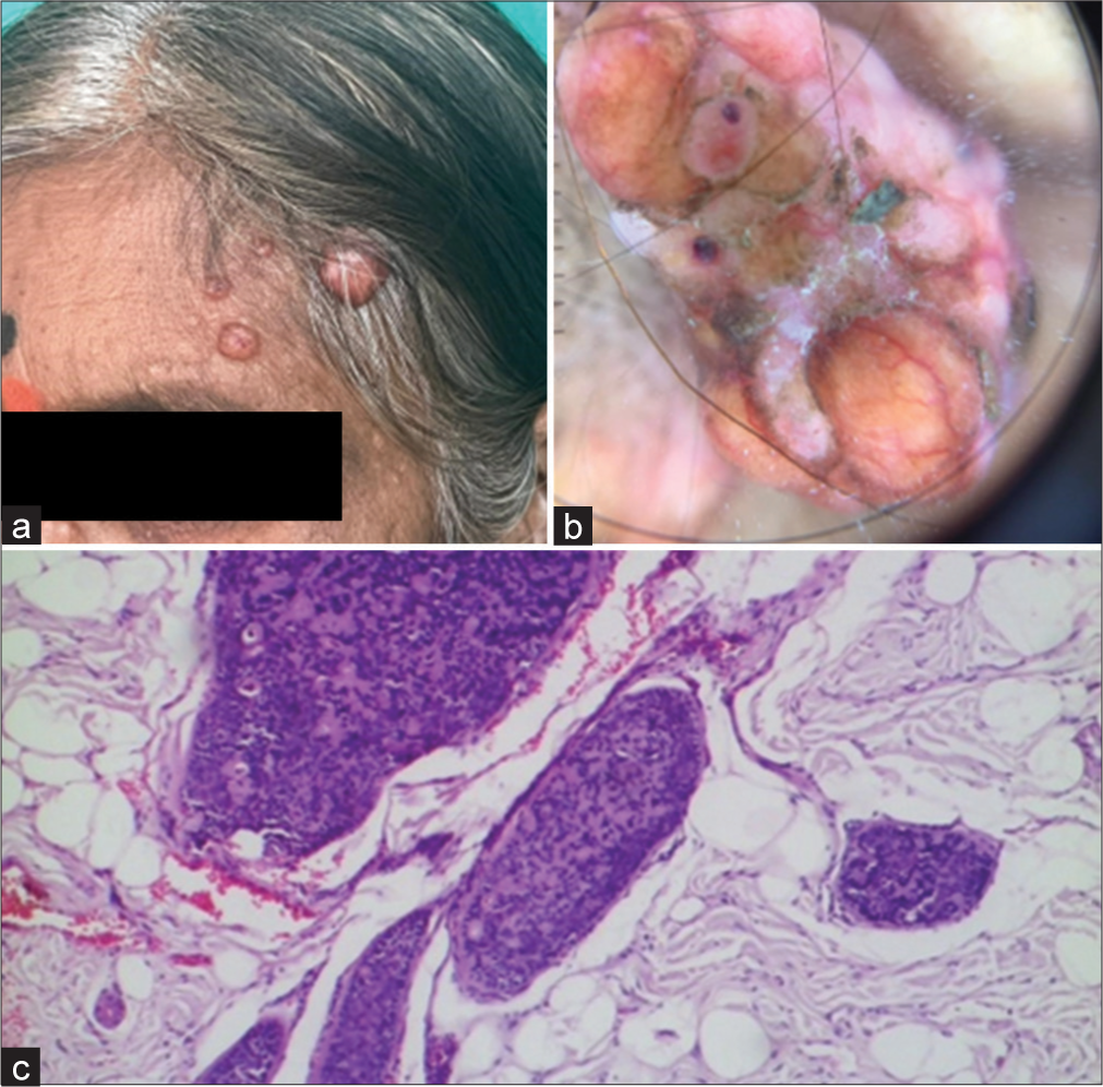 (a) Spiradenoma – clinical photograph showing multiple skin-colored nodules with a smooth surface. (b) Dermoscopy – multiple branched vessels with bluish-black clods. (c) Histopathology – multiple deeply basophilic lobules with collagenous core appearing as hazy areas seen within cords (Magnification ×100).