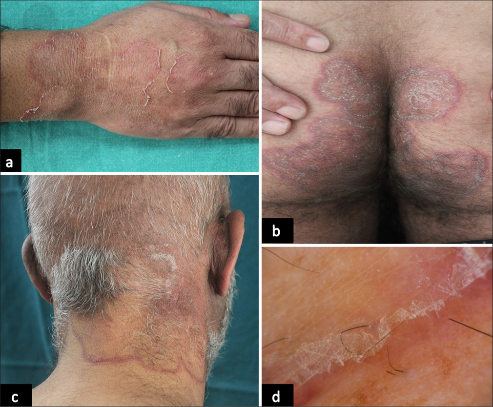 Well-defined annular plaque with central clearing and trailing scale and advancing erythematous border over dorsum of (a) the right hand, (b) buttock and (c) nape of neck, (d) dermoscopy of lesion showing whitish scale with advancing erythematous border (DermLite dl3 gen, ×10 magnification, Made in USA).