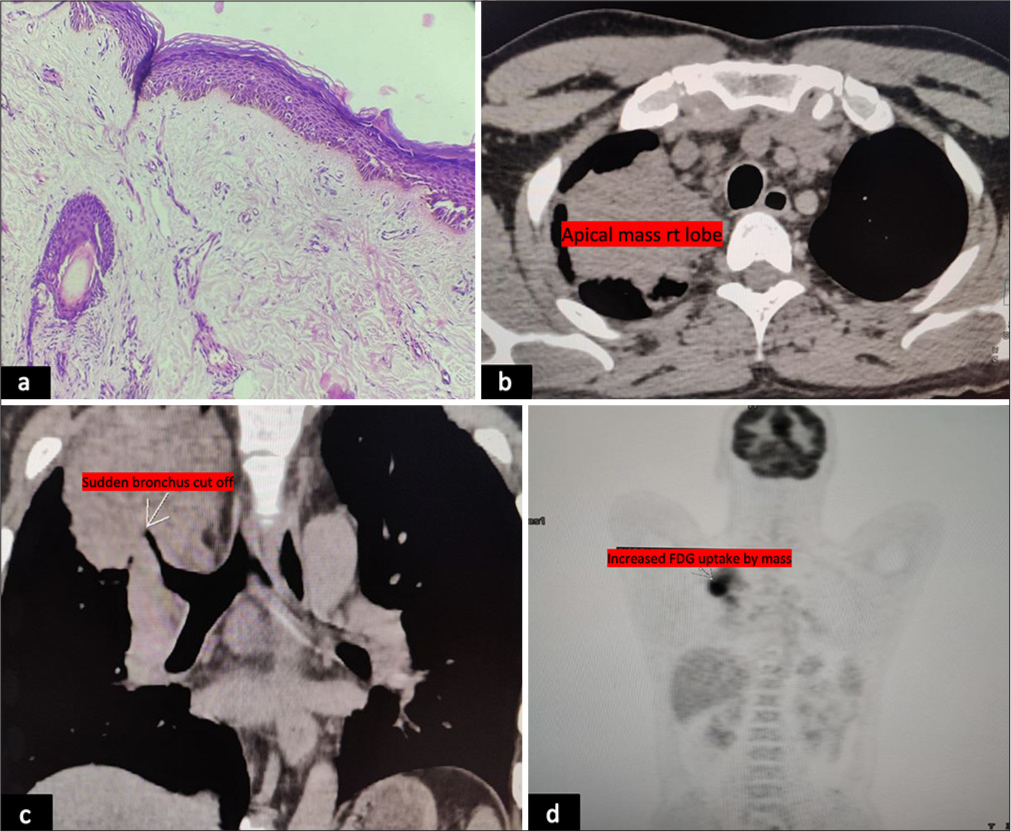 Histopathological examination showing orthokeratosis, minimal (a) spongiosis along with minimal perivascular and periadnexal lymphocytic infiltrate (Haematoxylin and eosin, ×100), (b and c) high-resolution computed tomography showing mass in the right upper lobe of lung and (d) positron emission tomography scan showing avid uptake in the upper lobe of the right lung.