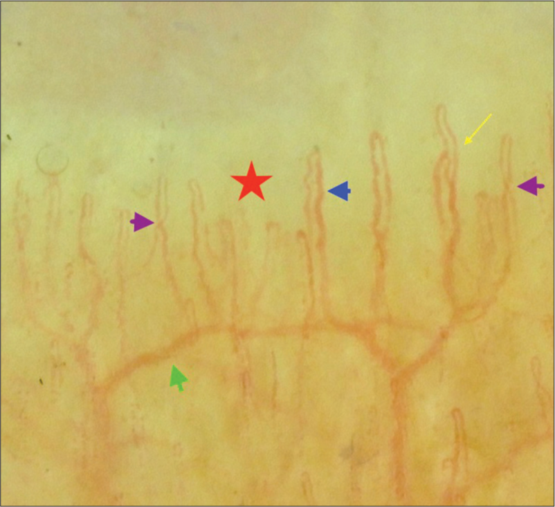 Nailfold capillaroscopy of psoriatic patient with metabolic syndrome showing subpapillary venous plexus (green arrow), criss-cross capillary (purple arrows), avascular area (red star) ramified capillary (yellow arrow) and dilated capillary (blue arrow).