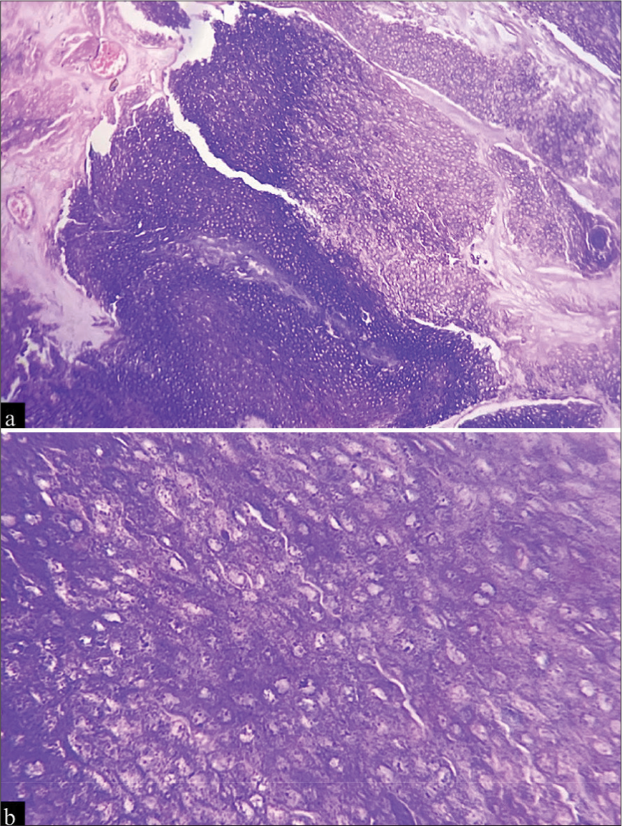 (a) A well-demarcated tumour containing calcifications, foreign body cells, and ghost cells with eosinophilic cytoplasm and islands of epithelial cells, including basaloid matrical cells (H&E, ×10), (b) anucleated ghost (or shadow) cells (H&E, ×40). H&E: Haematoxylin and eosin.