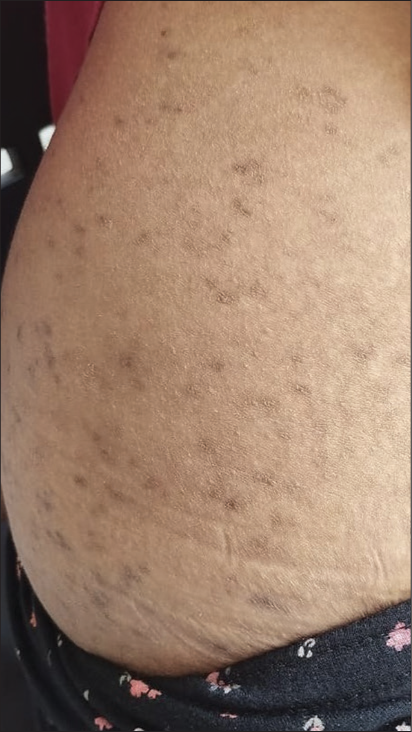 Hyperpigmentation after application of resorcinol 5% combined with sulphur 5% lotion for truncal acne.