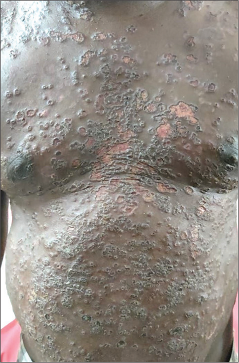 Punched out polycyclic erosions of eczema herpeticum in pemphigus vulgaris.