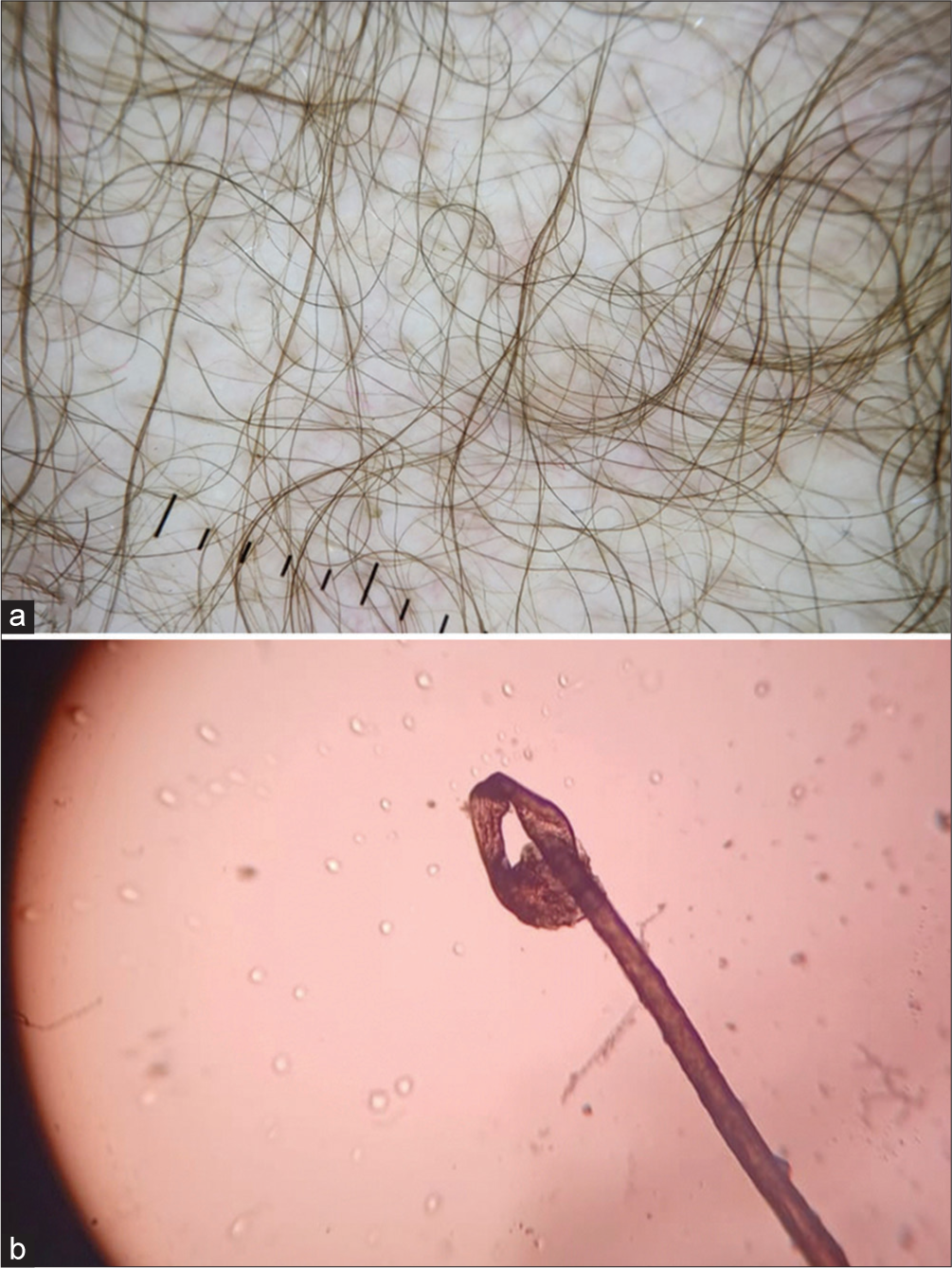 (a) Trichoscopic examination revealing thin, fine, curled and predominantly single hair shafts without any evidence of inflammation (×10, DL4). (b) Light microscopy revealing dystrophic anagen hair root with cuticle weathering.