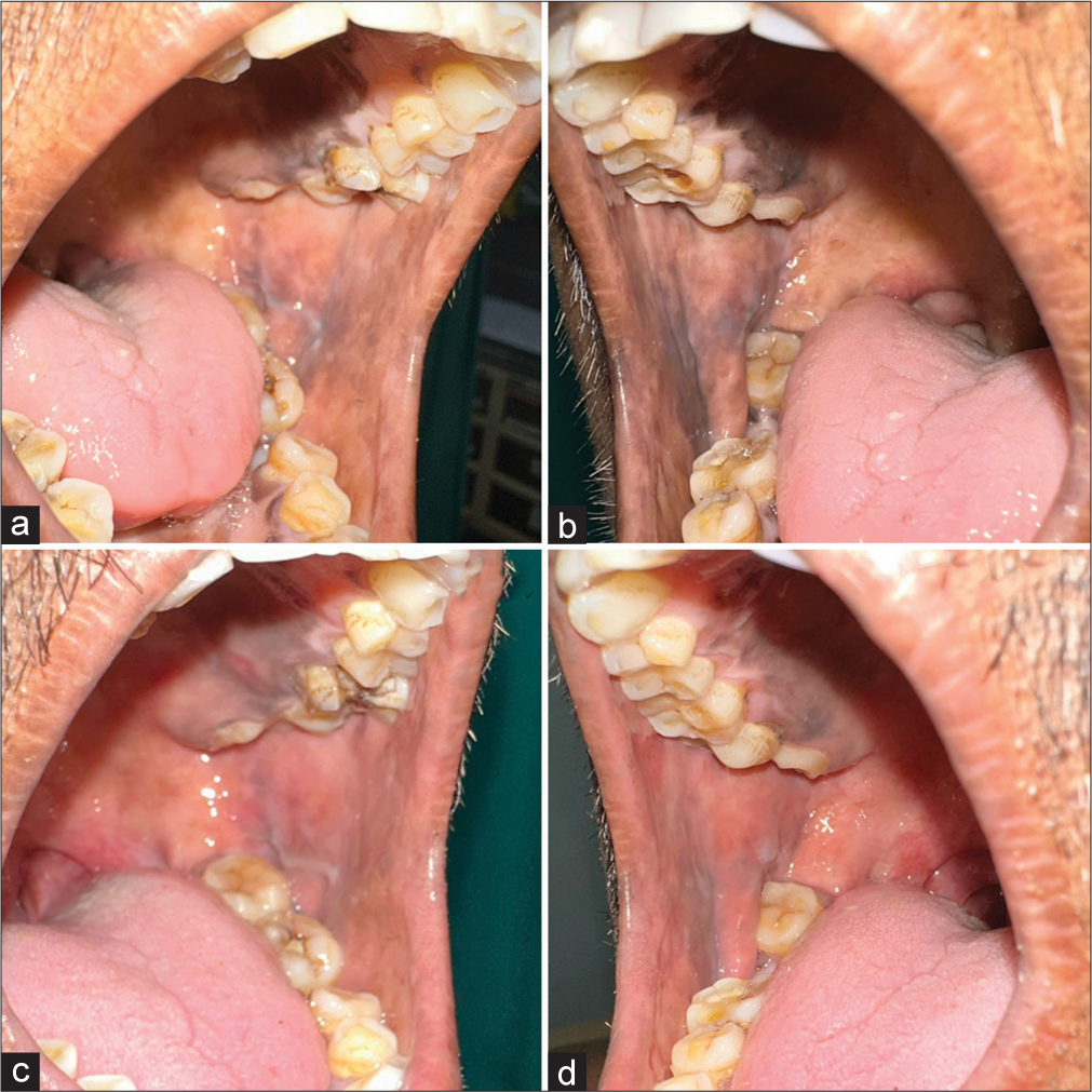 (a and b) Hyperpigmentation over bilateral buccal mucosa. (c and d) Resolution of hyperpigmentation after treatment.