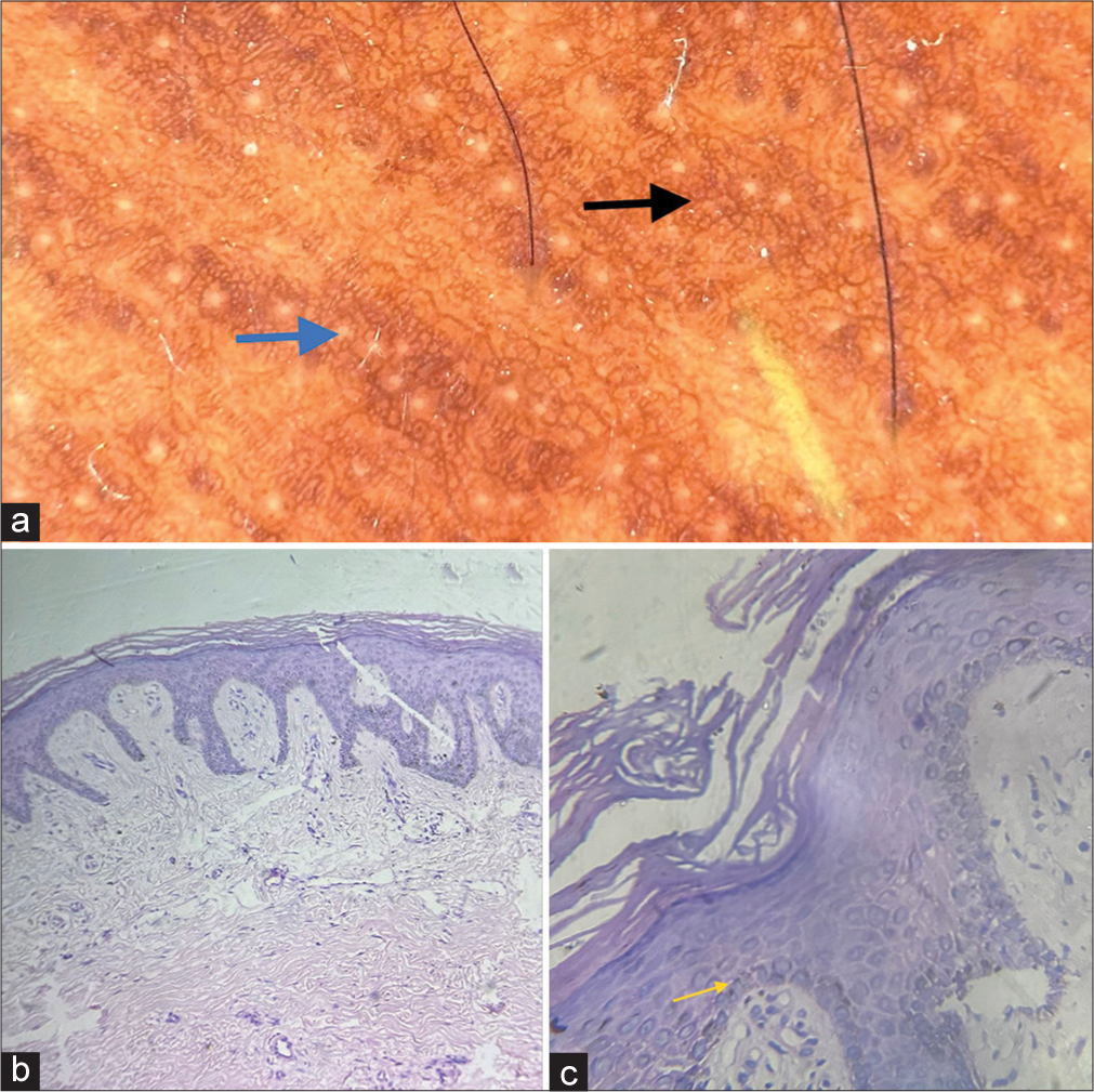 (a) Dermoscopy (Heine’s 30, 10× magnification, nonpolarised mode) shows brown reticular areas forming a pseudo network like pattern (black arrow) around eccrine gland openings (blue arrow). (b) Hematoxylin and eosin-stained section – 10× view shows hyperkeratosis, mild acanthosis with elongation of rete ridges, increased melanin in the basal layer. (c) Hematoxylin and eosin-stained section – 40× view shows magnified image of hyperkeratosis, acanthosis, increased melanin in the basal layer (yellow arrow) and pigment incontinence in superficial dermis.