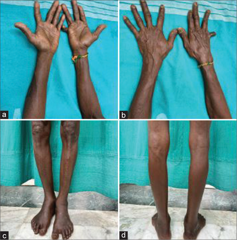 (a) Post treatment reversal of hyperpigmentation over flexor aspect of both forearms and palms. (b) Post treatment reversal of hyperpigmentation over extensor aspect of both forearms and dorsum of hands. (c) Post treatment reversal of hyperpigmentation over anterior aspect of both lower legs and feet. (d) Post treatment reversal of hyperpigmentation over posterior aspect of both lower legs and feet.