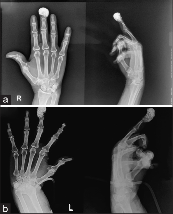 (a) X-ray of the right hand (homogenous white deposition in pad of the distal phalanx of bilateral middle finger) (b) X-ray of the left hand (homogenous white deposition in pad of the distal phalanx of bilateral middle finger).