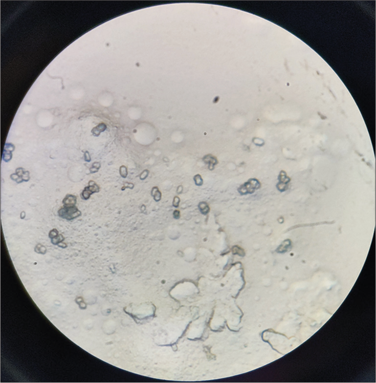 10% potassium hydroxide (KOH) mount showing small round light brown coloured bodies lying singly and in groups called copper penny bodies, medlar bodies and muriform or sclerotic cells diagnostic of chromoblastomycosis (×100, KOH).