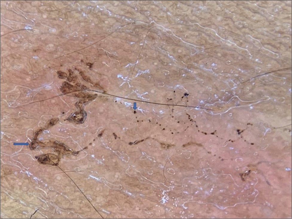 Dermoscopy image (DermLite, × 10, polarised mode) revealed brownish linear serpiginous tracts (larval body) with brownish dots (empty larval tract) suggestive of cutaneous larva migrans.