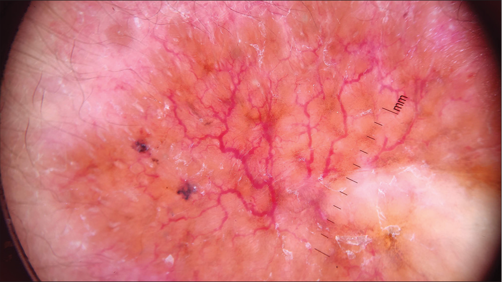 Dermatoscopy showing linear focussed telangiectasias on a yellow-brown background and white scales (DermLite DL3N; dry, contact, polarised, ×10).