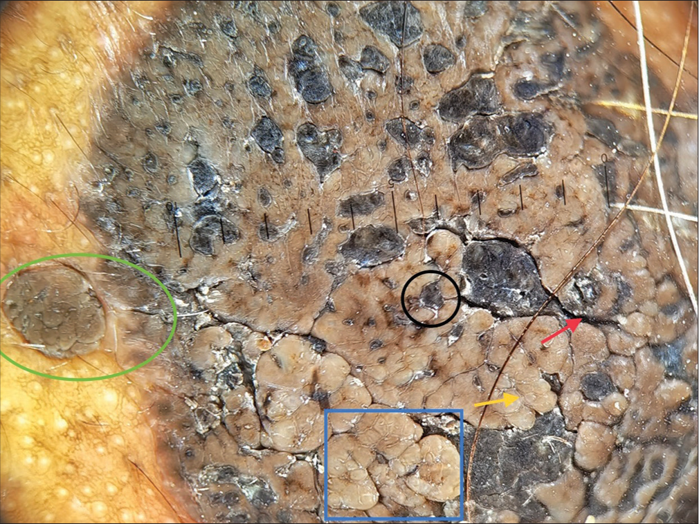 Dermoscopy (Heine’s 20T, non-polarised mode) shows comedo-like openings (black circle), fissures (red arrow), crypts (yellow arrow), cerebriform pattern (blue box) and globular pattern (green circle).