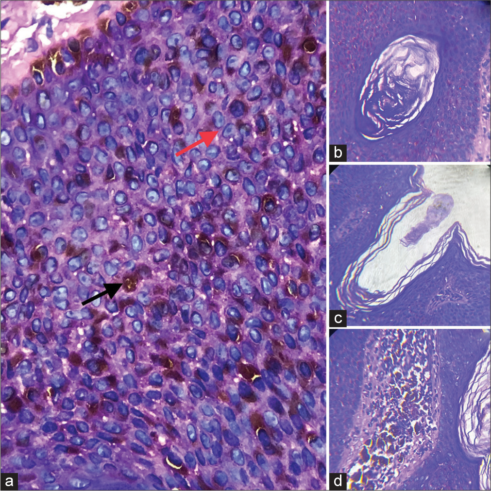 (a) Haematoxylin and eosin (H&E)-stained section (×40 view) shows basaloid cells (red arrow) with scattered melanocytes (black arrow). (b) H&E section shows true horn cyst. (c) H&E section shows pseudo horn cyst. (d) H&E section shows scattered melanocytes.