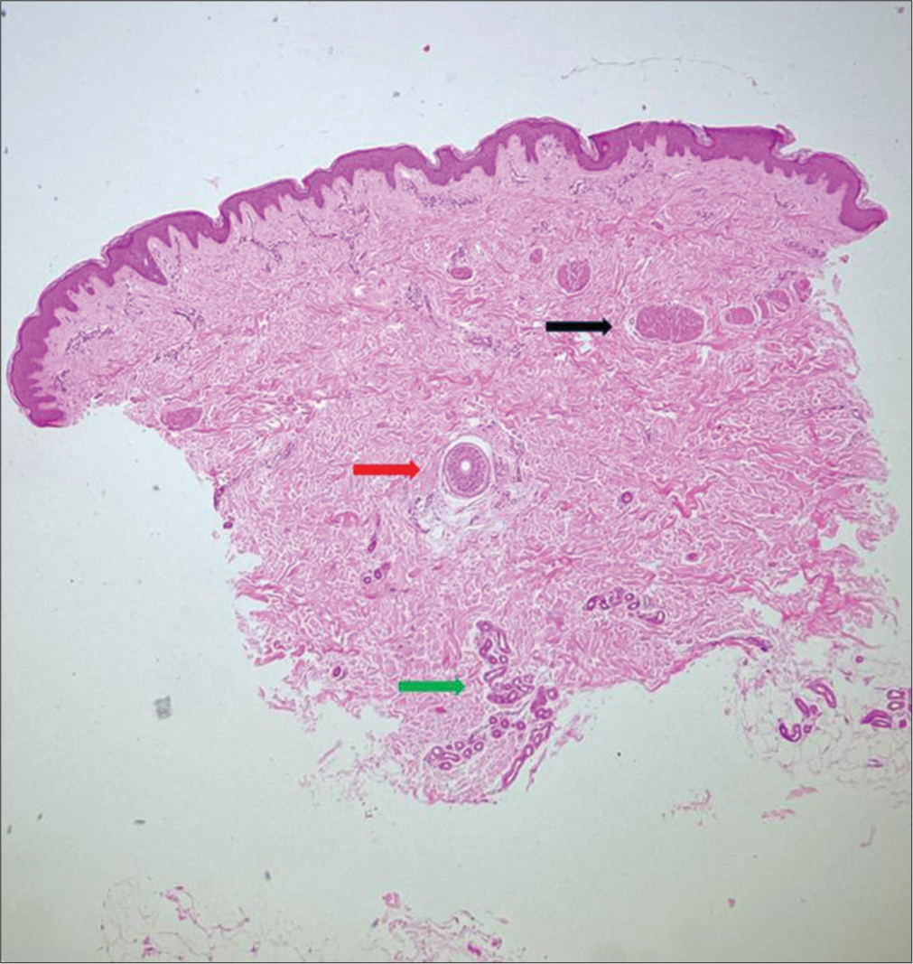 Normal skin biopsy showing epidermis, dermis and apical part of subcutaneous tissue. Note that the epidermal side has been placed on top as convention. Adnexal structures seen are arrector pilorum muscle (black arrow), hair follicle (red arrow), eccrine glands and ducts (green arrow) [Haematoxylin and eosin (H and E), x40].