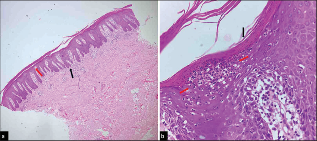 Plaque psoriasis. (a) Parakeratotic compact stratum corneum, acanthosis in the form of regular club-shaped elongations of rete ridges, described as camel foot appearance (black arrow), suprapapillary thinning (red arrow), superficial perivascular moderate infiltrate [Haematoxylin and eosin (H and E), x100], (b) High power of spongiform pustule of Kogoj in upper spinous layer showing neutrophils along with spongiosis, resembling a sponge (between red arrows). Also note the lack of granular layer and flat parakeratosis (black arrow) (H and E, ×400).